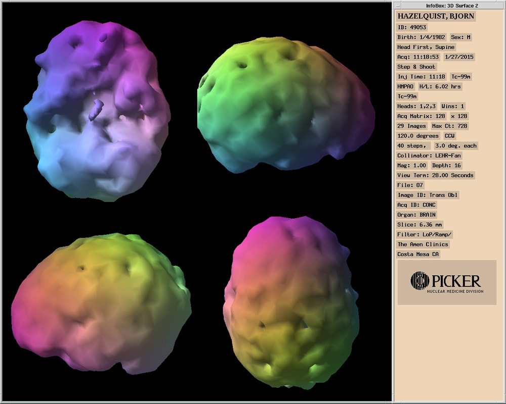 Bjorn's SPECT brain scan from Amen Clinics