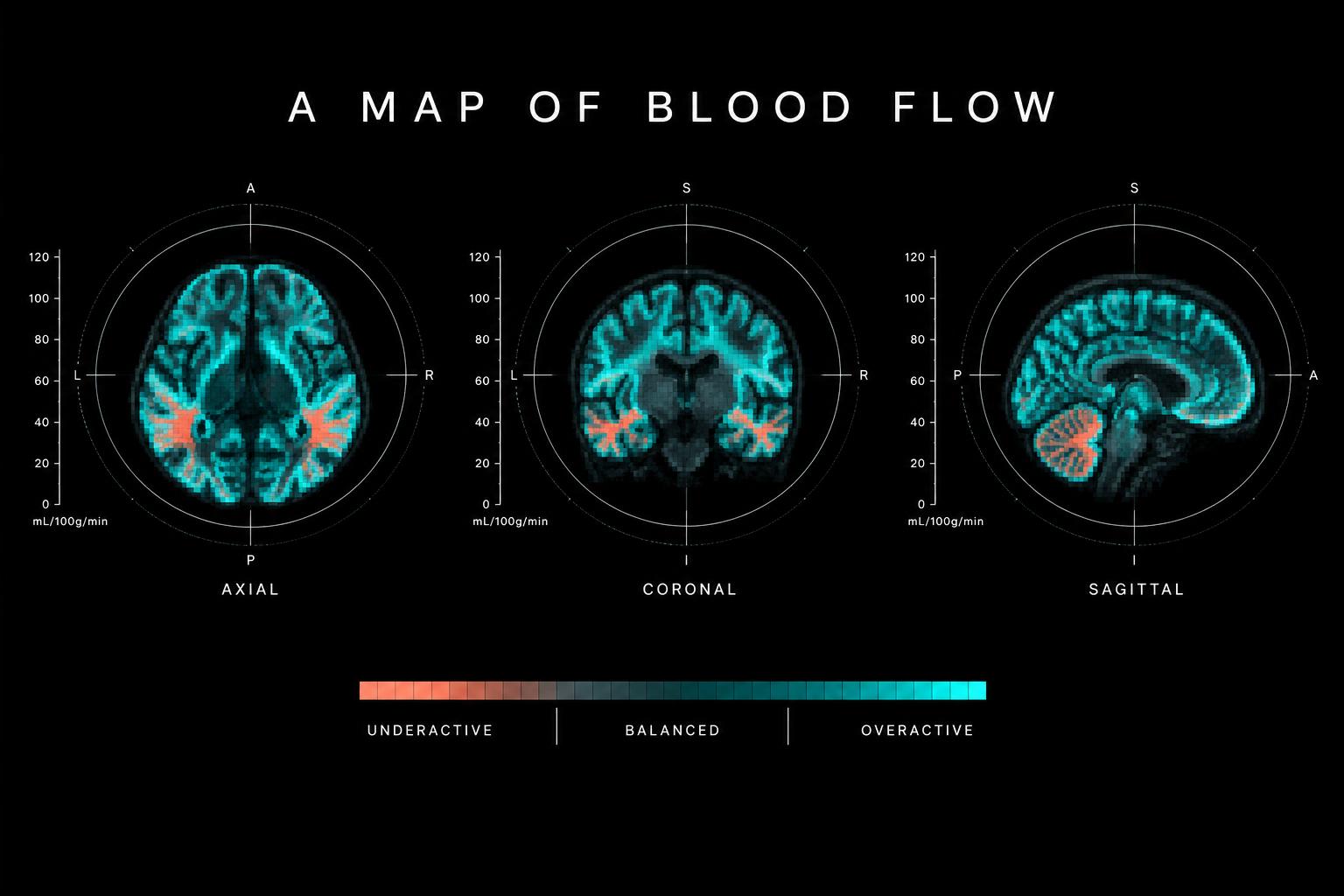 Axial, coronal, and sagittal SPECT views mapping underactive, balanced, and overactive brain perfusion.