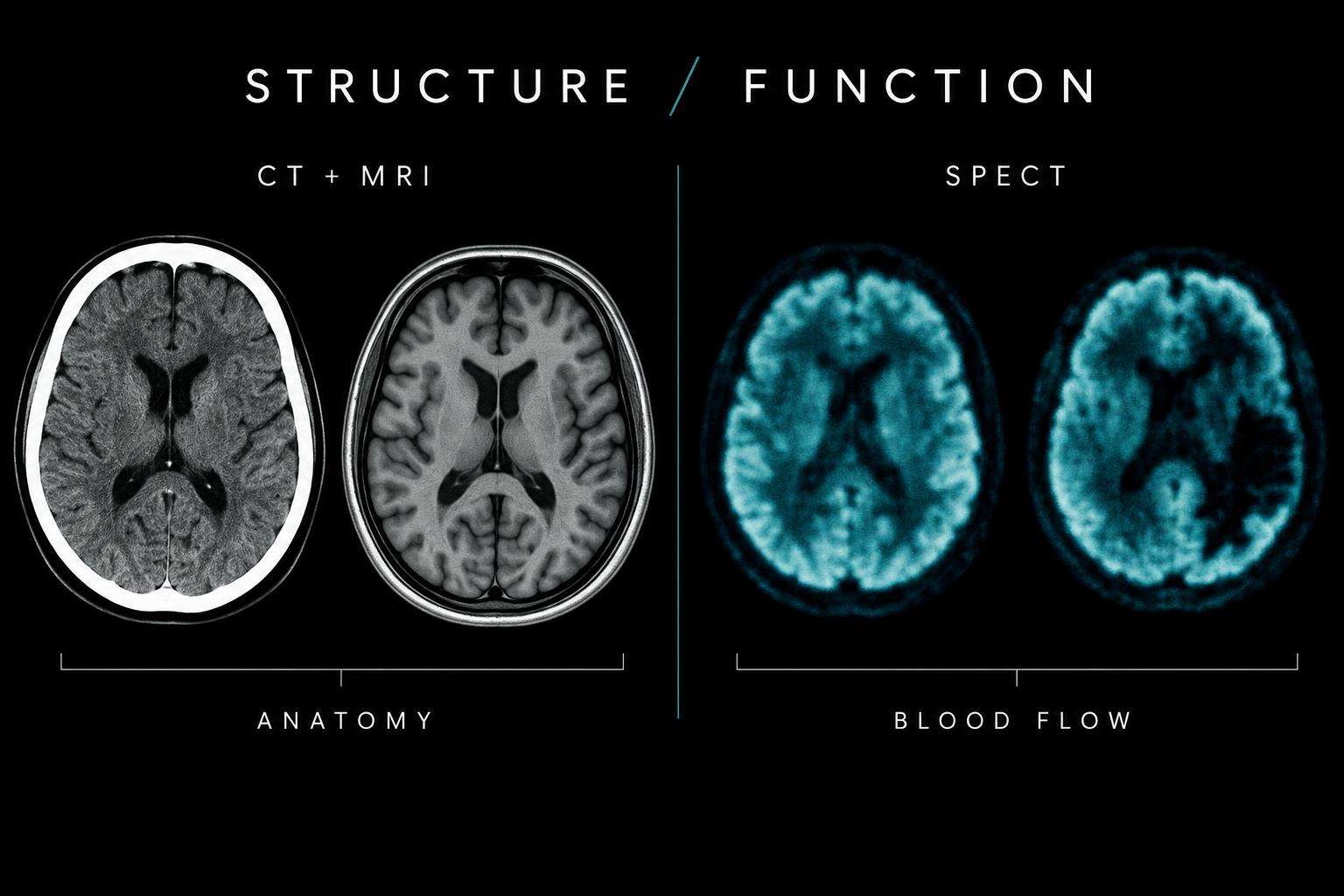 Structural CT and MRI brain scans compared with functional SPECT blood-flow images.